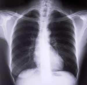 chest and lung x-ray