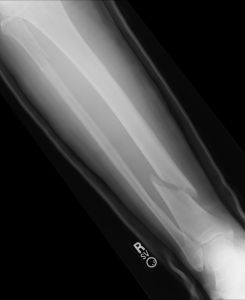 broken-leg-xrayseries-1-978477-m.jpg