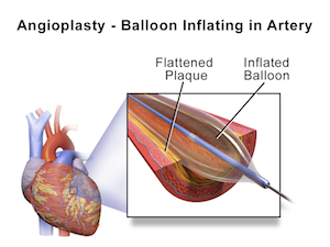 Balloon Inflating in Artery
