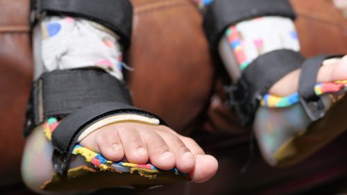 Child's feet in colorful orthopedic braces on a brown surface.