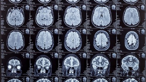Brain MRI scans displaying detailed internal neurological structures for medical evaluation.