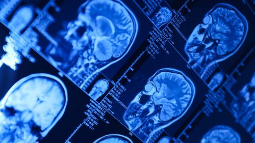 Blue-tinted brain scan images for medical analysis, highlighting potential diagnostic errors.