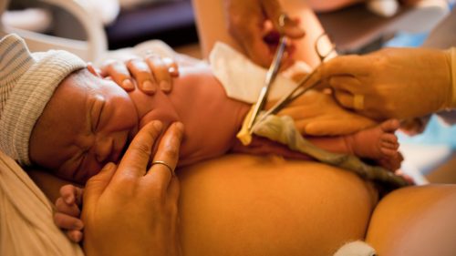 Newborn receiving medical care, umbilical cord being cut, surrounded by attentive staff.