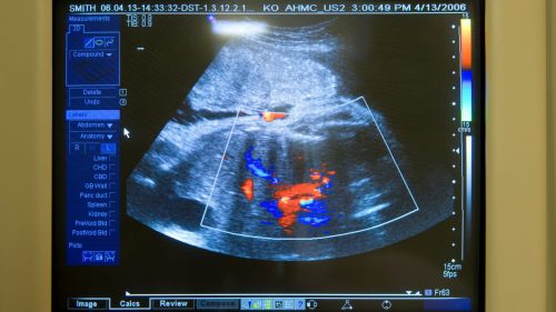 Ultrasound scan showing medical data on monitor, highlighting potential diagnostic discrepancies.